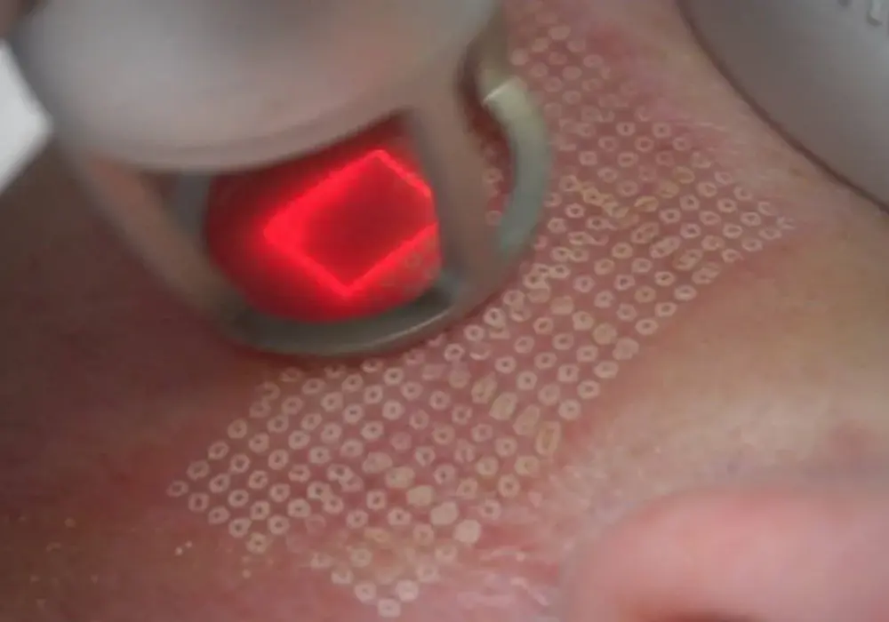 Laser frakcyjny na co pomaga: poznaj jego skuteczne zastosowania