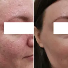 Ile trwa zabieg laserem frakcyjnym i co musisz wiedzieć przedtem