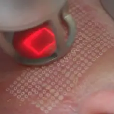 Laser frakcyjny na co pomaga: poznaj jego skuteczne zastosowania