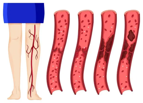 Jak sprawdzić czy żyły są zatkane - objawy i skuteczne metody diagnozy