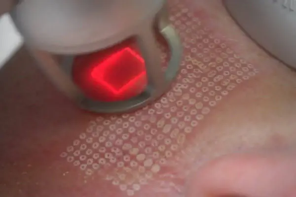 Laser frakcyjny na co pomaga: poznaj jego skuteczne zastosowania